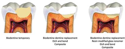 The scientific management of deep carious lesions in vital teeth using contemporary materials—A narrative review
